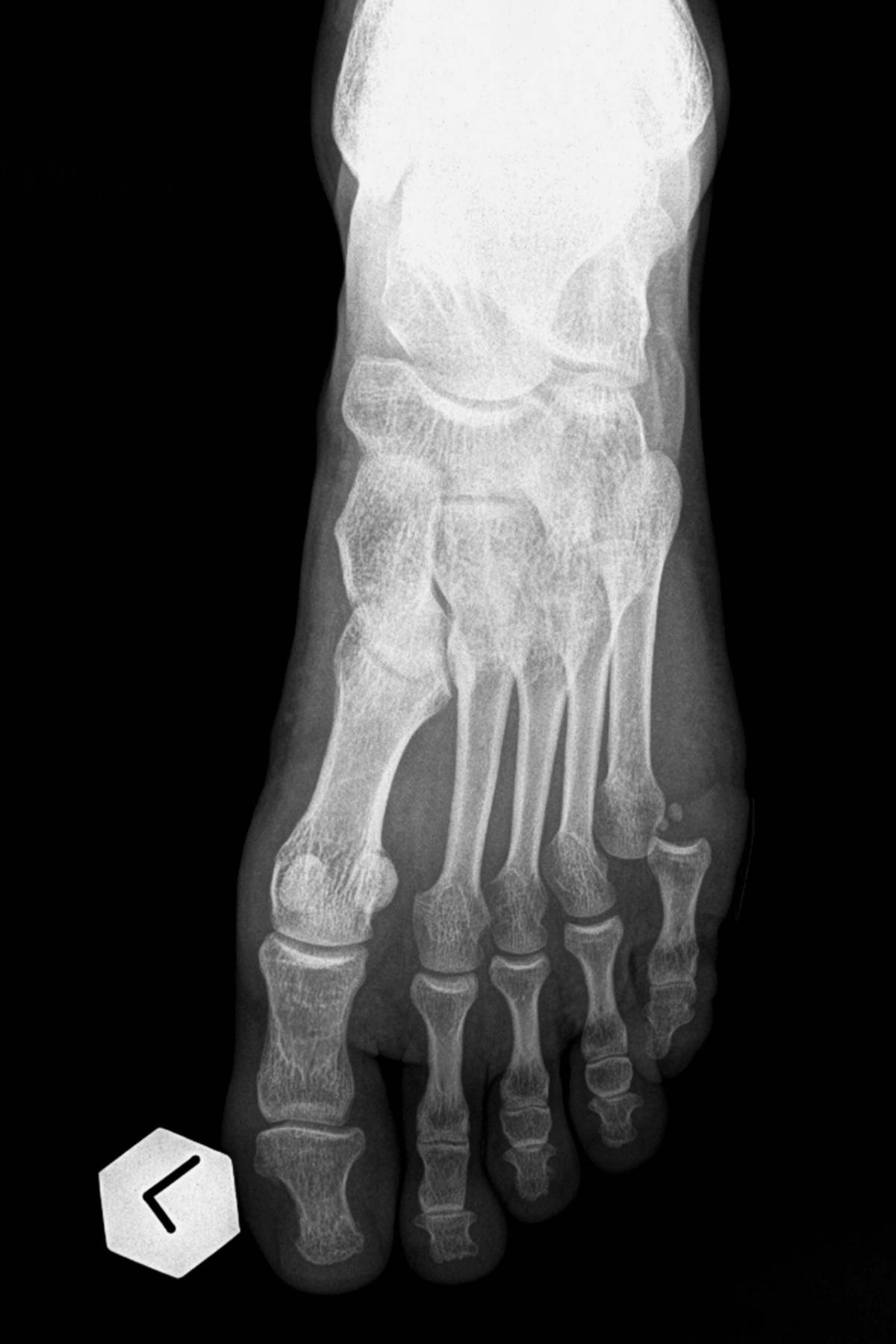 Illustration - Shutterstock | <a href="https://www.shutterstock.com/image-photo/fracture-foot-smallest-finger-591540128">Dzelaluddin</a>