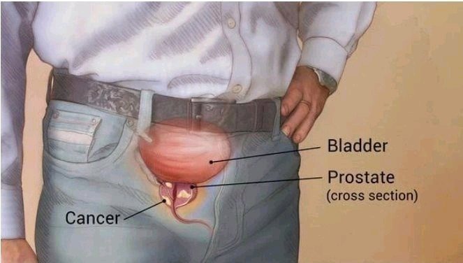 Five Early Warning Signs Of An Enlarged Prostate That Every Man Need To Know