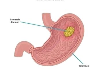 Stomach Cancer Kills Fast, Avoid Too Much Intake Of These 3 Things If You Want To Live Long