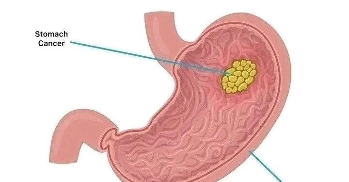 Stomach Cancer Kills Fast, Avoid Too Much Intake Of These 3 Things If You Want To Live Long