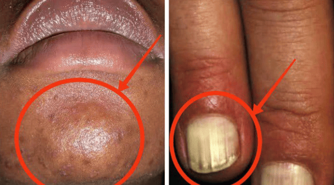 Signs And Symptoms Of HIV You Need To Notice Before Going For Test