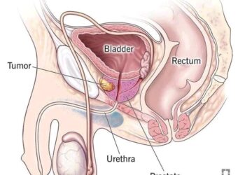 What Men Should Do To Reduce The Risk Of Prostrate Enlargement As They Grow Older