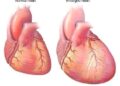 Protect Your Heart From Heart Failure By Avoiding Too Much Intake Of These Three Things
