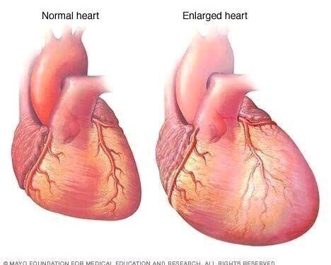 Protect Your Heart From Heart Failure By Avoiding Too Much Intake Of These Three Things
