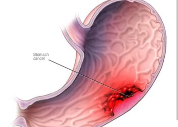 Stomach Cancer Often Comes Quietly – Doctors Warn Against Overusing These 3 Everyday Things
