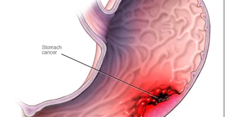 Stomach Cancer Often Comes Quietly – Doctors Warn Against Overusing These 3 Everyday Things